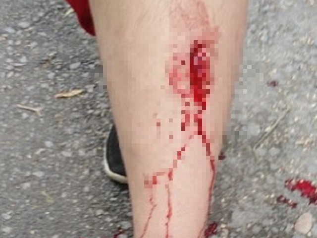 В Челябинской области девочка ранила ногу, спускаясь по лестнице