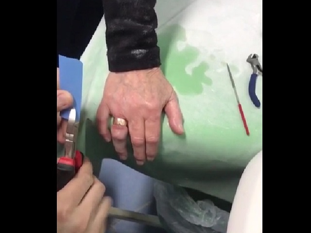 Южноуральские спасатели освободили палец пенсионерки от кольца, которое она не снимала полвека