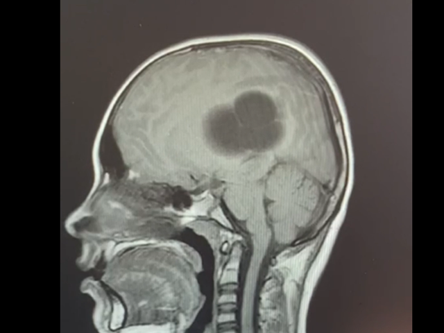 Челябинские нейрохирурги извлекли из мозга ребенка кисту с личинками паразита 