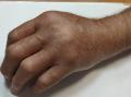 Южноуральский пенсионер попал в больницу после укуса гадюки в палец
